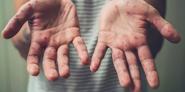 Penyakit monkeypox, adakah kita di Malaysia perlu risau?